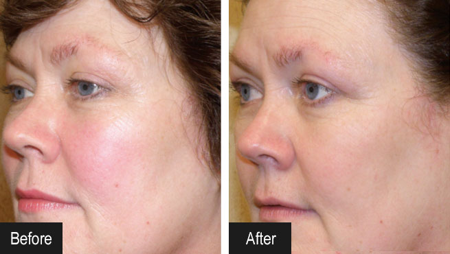 Before/After Gallery Dermatology Treatments | Rao Dermatology