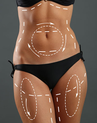 Patient C - Post-Operative Back & Bra line and Hips Liposuction — Dr  Giuffre Plastic Surgeon Edmonton