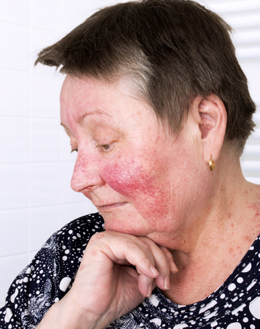 Rosacea Treatments Edmonton