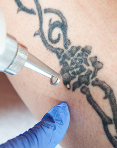 Tattoo Removal Edmonton