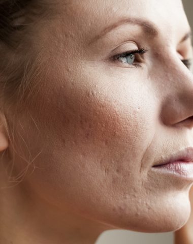 acne scarring treatment edmonton