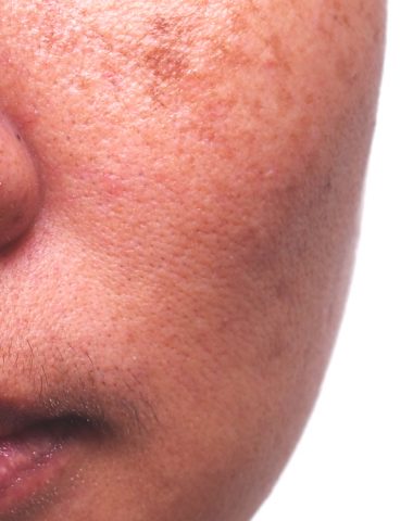 age spots treatment